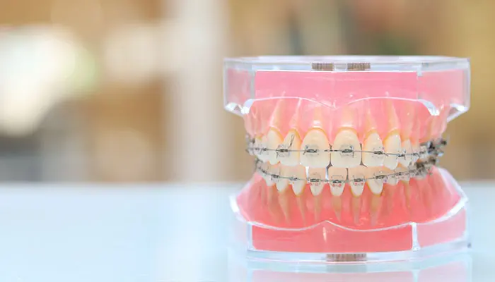 ブラケット（ワイヤー矯正）