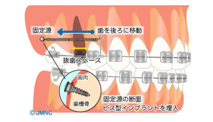 インプラント矯正